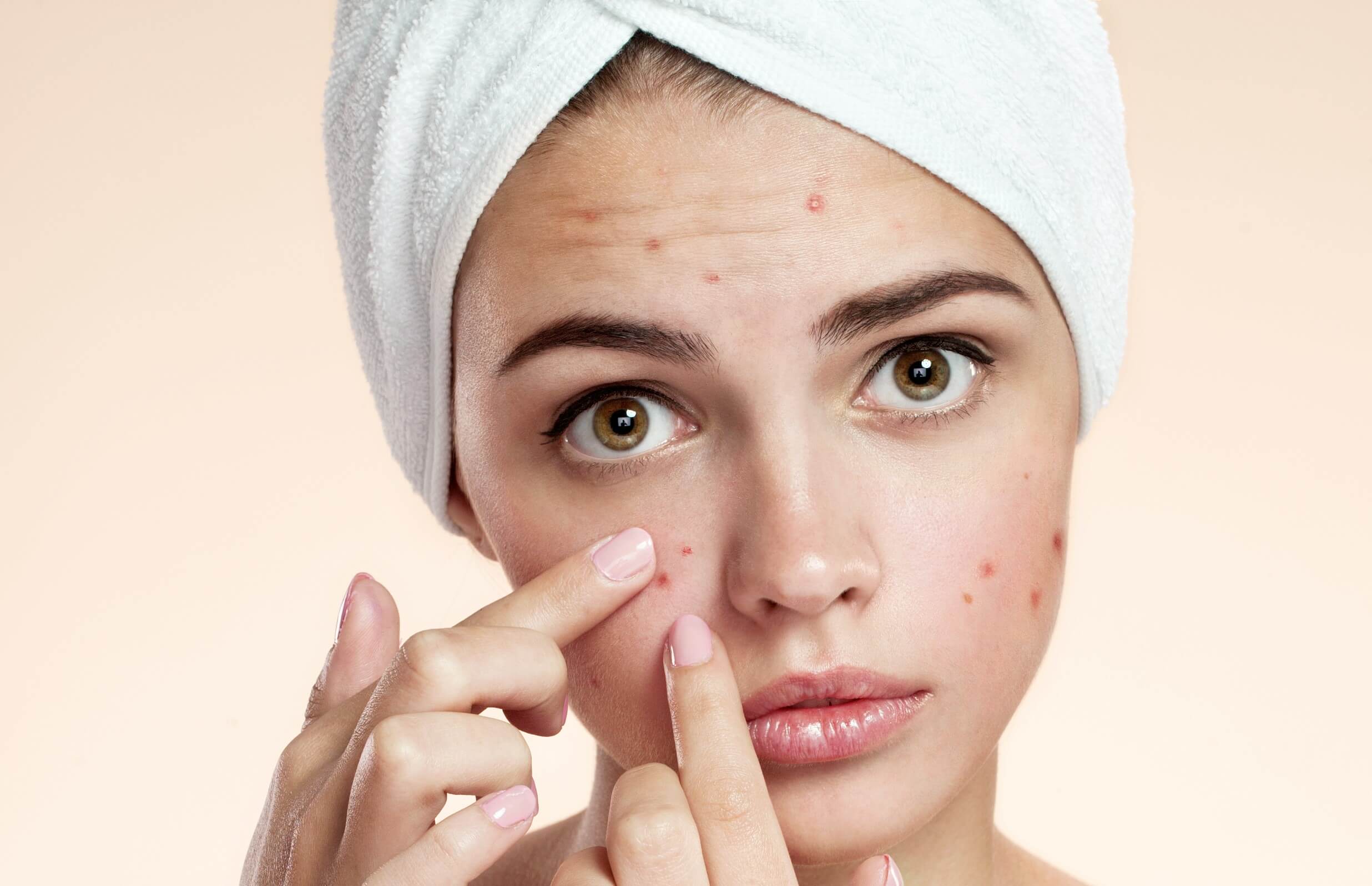 Remedy for Acne
