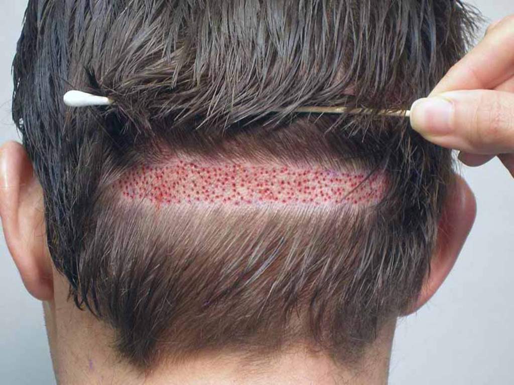 what is a hair transplant surgery LEWIGS